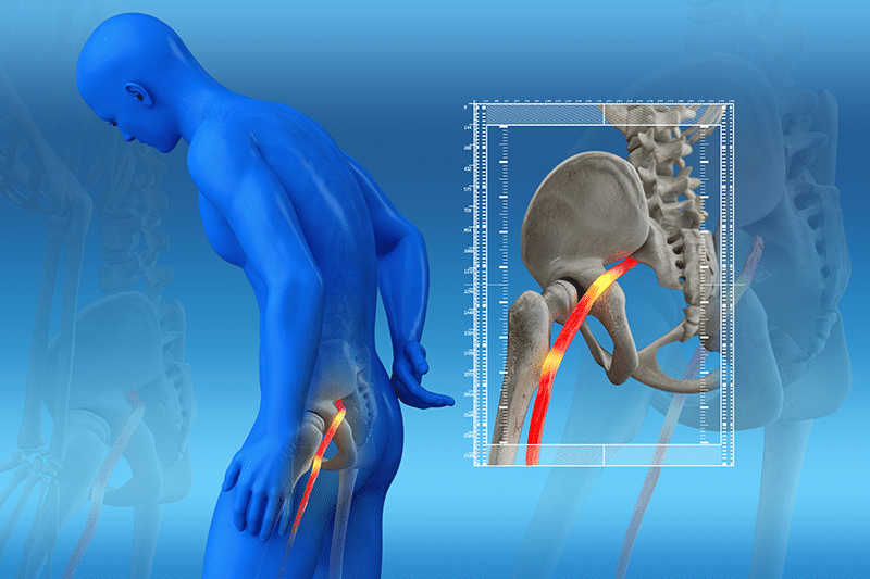 Lower Back Pinched Nerve Causes, Symptoms & Treatment - MSP