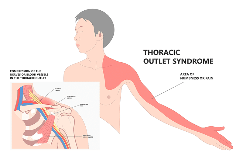 Thoracic Outlet Syndrome _ Momentum Medical - graphic