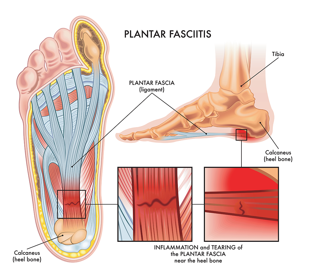 Shockwave Therapy for Plantar Fasciitis in central florida