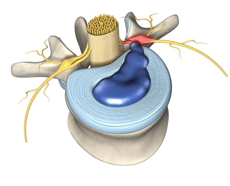 Descripción general de la radiculopatía torácica | Momento médico