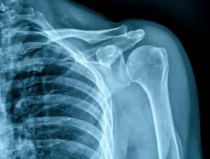 Illustrative shoulder X-ray showing the collarbone, shoulder joint, and upper arm.